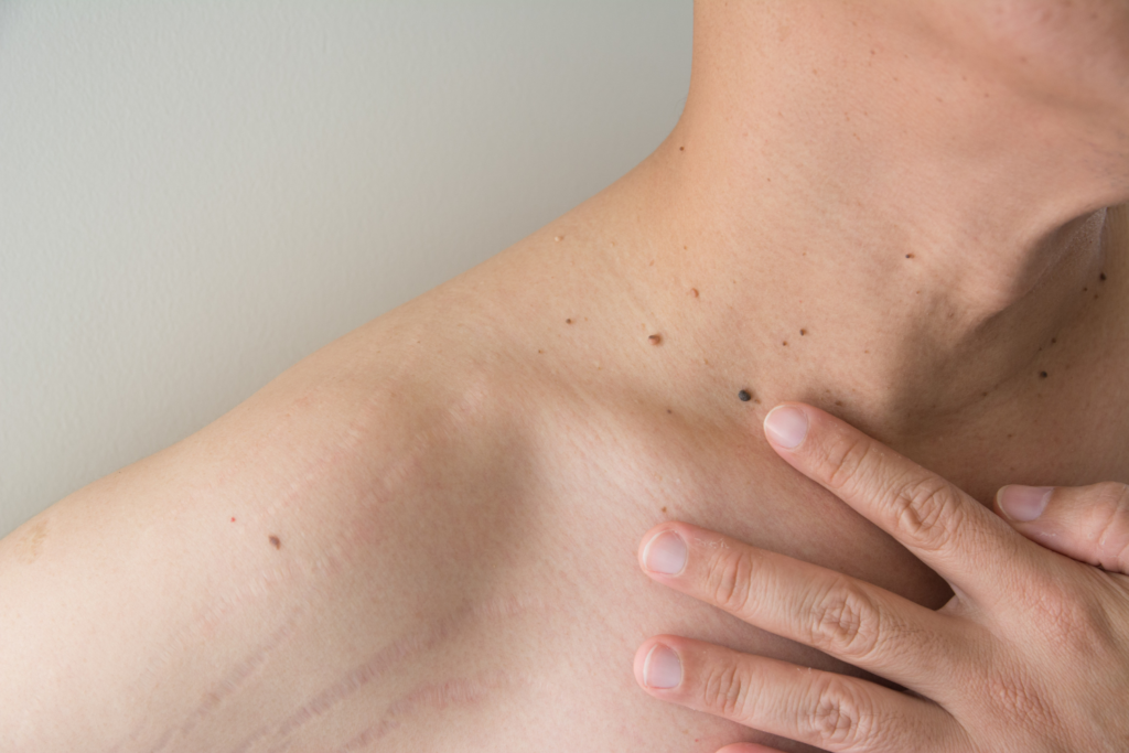 melanoma