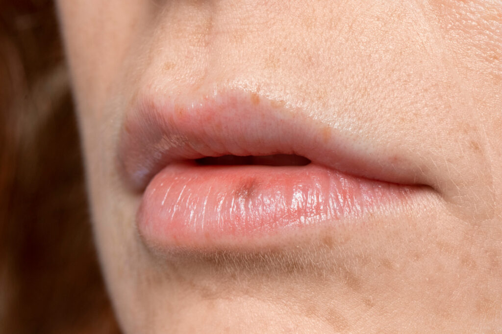 herpes labial